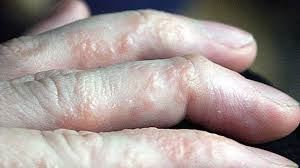 Picture for category Eczema